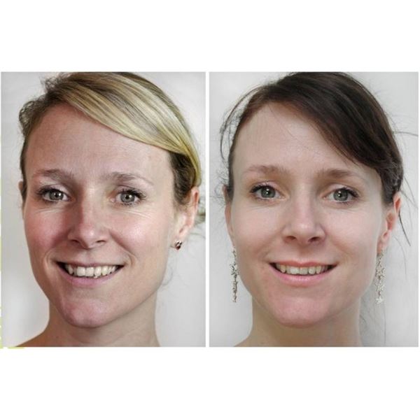 Dermaroller 540 needles with Titanium needles 0.5mm for the face - | Fashiongirl